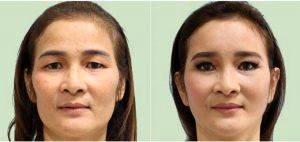 Dr Kamol Pansritum, MD, Thailand Plastic Surgeon - Facelift Before After Results