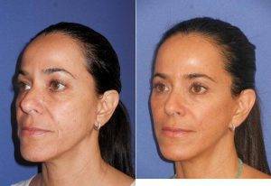 Dr Max Polo, MD, Miami Plastic Surgeon - 50 Year Old Woman Treated With Facelift
