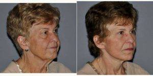 Dr Patricia Yugueros, MD, Atlanta Plastic Surgeon - 71 Year Old Woman Treated With Facelift