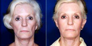 Dr Stephen J. Ronan, MD, FACS, San Francisco Plastic Surgeon - 66 Year Old Woman Treated With Facelift