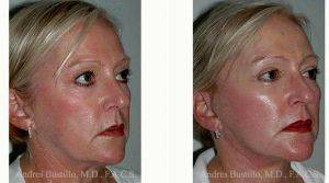 Dr. Andres Bustillo, MD, FACS, Miami Facial Plastic Surgeon - 58 Year Old Woman Treated With Facelift