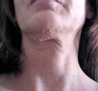 Dr. Jamil Asaria Surgery Face Patient Image Results