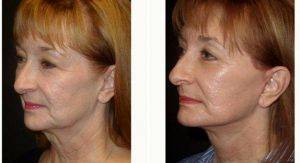 Dr. Jeff Angobaldo, MD, Dallas Plastic Surgeon - 45 Year Old Woman Treated With Facelift