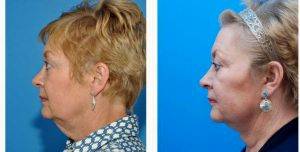 Dr. Mark Beaty, MD, Atlanta Facial Plastic Surgeon - 52 Year Old Woman Treated With Facelift