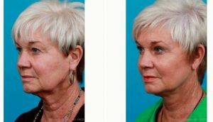 Dr. Michael A. Bogdan, MD, FACS, Dallas Plastic Surgeon - 72 Year Old Woman Treated With Facelift Before And After 548