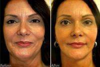 Endoscopic Facelift Before After Photo