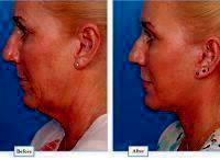 Endoscopic Facelift Before And After