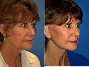 Face Lift By Dr. Ross A. Clevens, MD, Melbourne Facial Plastic Surgeon