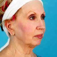 Facelift And Pre-jowl Implant