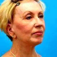 Facelift And Pre-jowl Implant 3