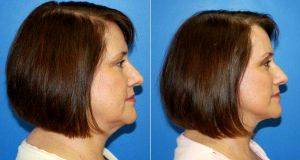 Facelift By Doctor Paul S. Gill, MD, Houston Plastic Surgeon