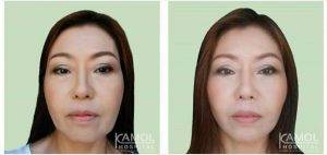 Facelift By Dr Kamol Pansritum, MD, Thailand Plastic Surgeon