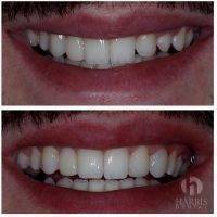 Facelift Dentures Before And After (1)