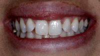 Facelift Dentures Before And After (10)