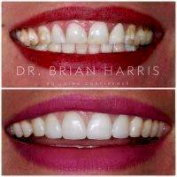 Facelift Dentures Before And After (11)