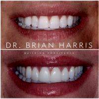 Facelift Dentures Before And After (16)