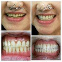 Facelift Dentures Before And After (19)