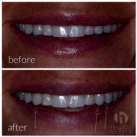 Facelift Dentures Before And After (2)