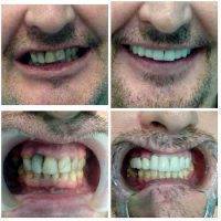 Facelift Dentures Before And After (22)