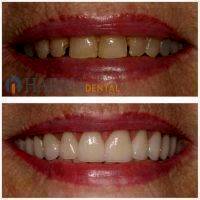 Facelift Dentures Before And After (26)