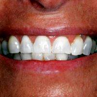 Facelift Dentures Before And After (27)