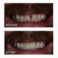 Facelift Dentures Before And After (29)