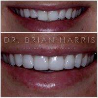 Facelift Dentures Before And After (3)