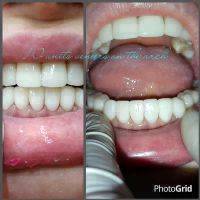 Facelift Dentures Before And After (30)