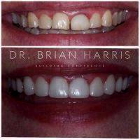 Facelift Dentures Before And After (6)