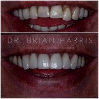 Facelift Dentures Before And After (8)