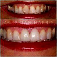Facelift Dentures Before And After (9)