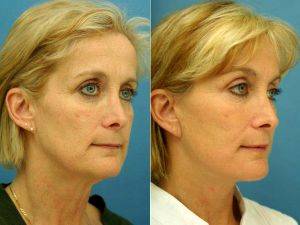 Facelift Forehead Lift With Dr. Minas Constantinides, MD, Austin Facial Plastic Surgeon