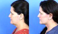 Facelift Jowls Before And After Picture