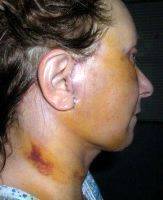 Facelift Lumps And Bumps May Occur For A Number Of Different Reasons