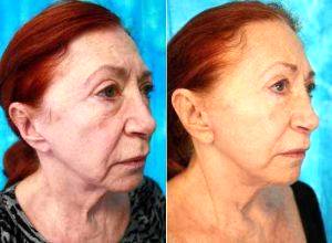 Female Face Lift Before And After By Dr Randy B. Miller, MD, Miami Plastic Surgeon