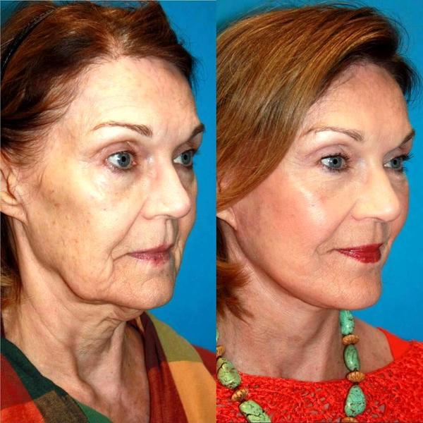 Full Face Lift Before And After Photo Facelift Info Prices Photos