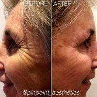 Galvanic Wrinkle Treatment Before And After