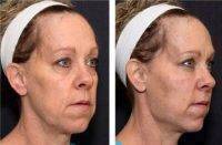 How Does A Liquid Facelift Work Photo