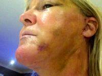 How Long For Swelling To Go Down After Facelift Surgery