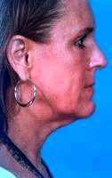 How To Minimize Jowls