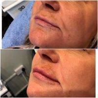 Images Of Before And After Vampire Facelift (2)