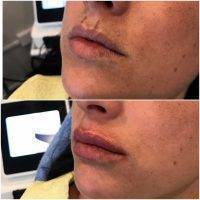 Images Of Before And After Vampire Facelift (4)