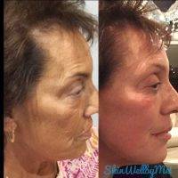 Images Of Before And After Vampire Facelift (5)