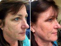 Images Of Before And After Vampire Facelift (6)