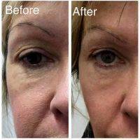 Laser Eyelift Procedure Before And After
