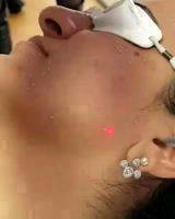 Laser Face Lift In Houston Tx