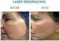Laser Resurfacing Before And After Photo