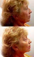 Liquid Facelift Before And After Photos