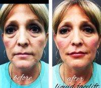 Liquid Facelift Hawaii Before And After