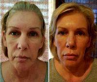 Liquid Facelift In Phoenix Before And After